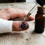 Cum să scapi de o pată întunecată sub o unghie după o lovitură folosind o metodă dovedită cum-sa-scapi-de-o-pata-intunecata-sub-o-unghie.webp.webp